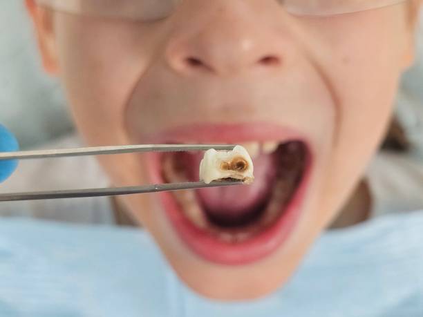 Best Knocked-Out Tooth (Avulsed Tooth) Treatment in New Madrid, MO
